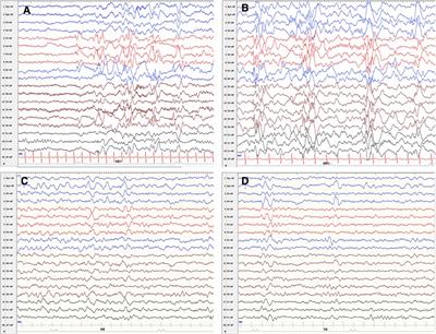 Infantile epileptic spasms syndrome as an initial presentation in infantile choroid plexus papilloma: A case report